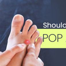 Should You Ever Pop a Blister?